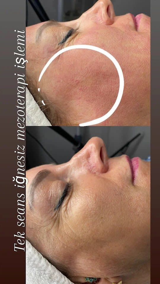 İğnesiz mezoterapi cilt uygulaması